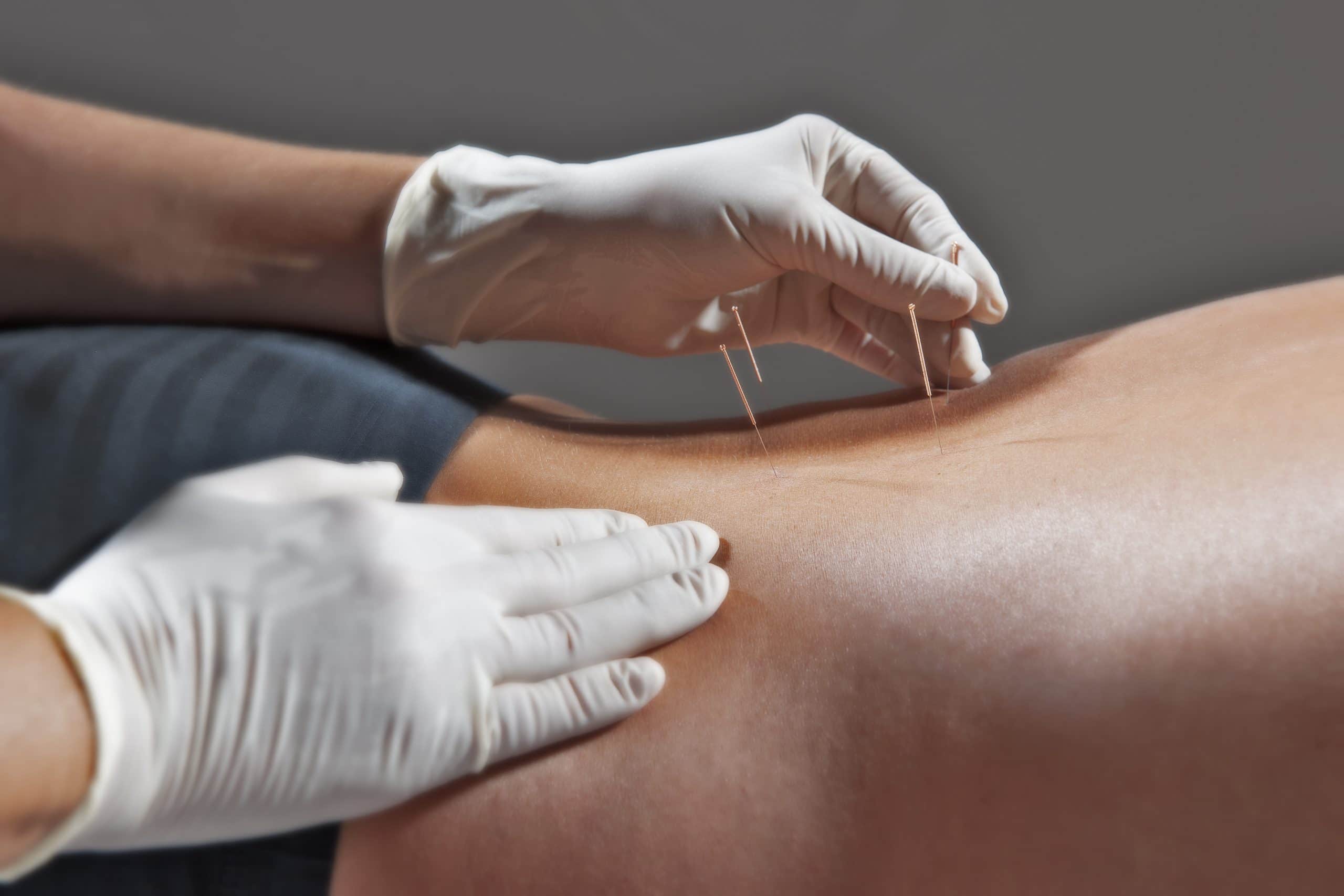 Zwischen-Tradition-und-Moderne-Akupunktur-im-Fokus-der-Heilung - Bitterkraft